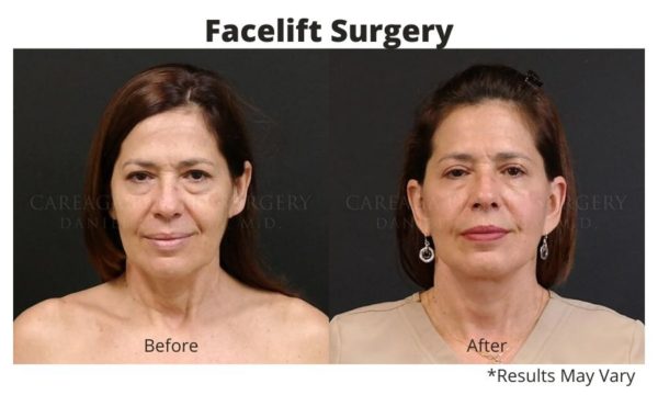 How Has Facelift Surgery Changed? A Look at the Ever-Evolving Anti ...